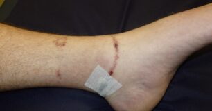 Image of an injury from cuffs on a leg